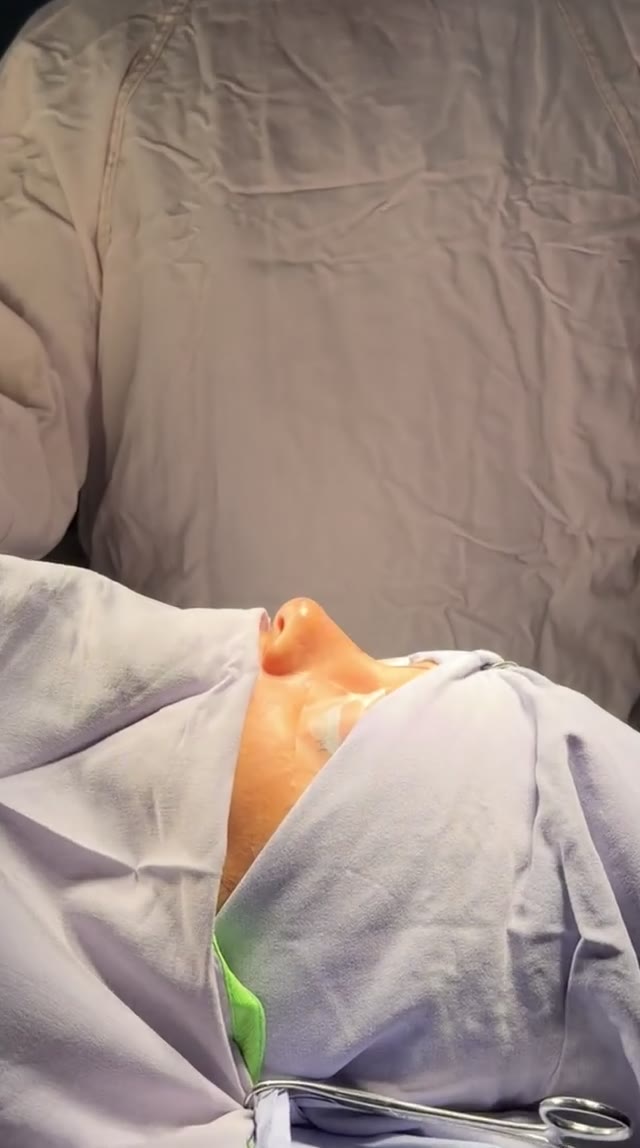 Caso de rinoplastia