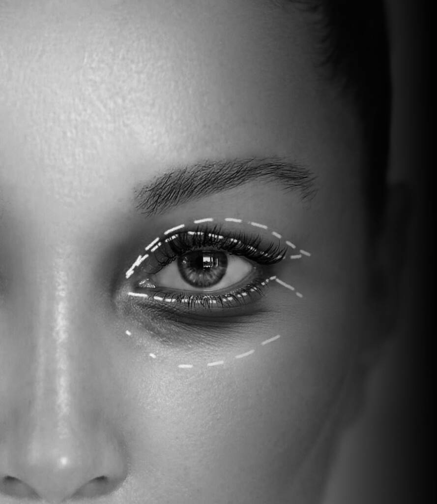 BLEFAROPLASTIA